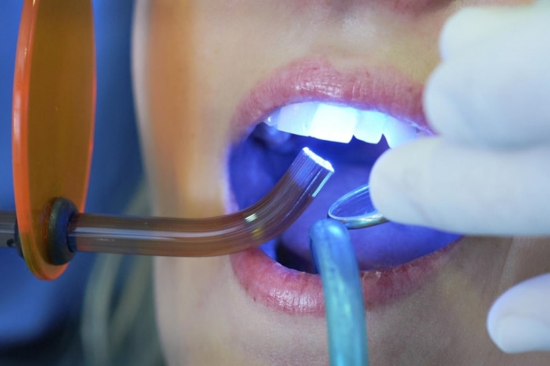 Пломбирование зубов: материалы и методы