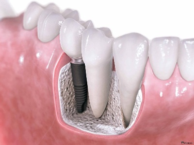 Имплантация зубов: установка зубных имплантов  в Махачкале