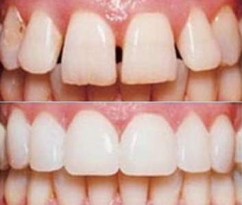 Эстетическая стоматология. Реставрация зубов  в Махачкале