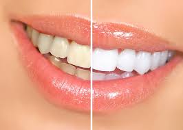 Решили придать улыбке больше яркости? Обращайтесь в «Стоматологию 32» в Махачкале
