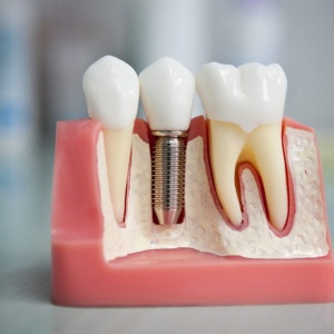 Современные технологии протезирования зубов в "Стоматология-32"