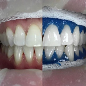 Как ухаживать за зубами после отбеливания