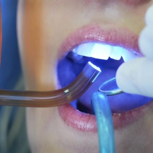 Пломбирование зубов: материалы и методы
