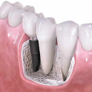 Имплантация зубов: установка зубных имплантов  в Махачкале