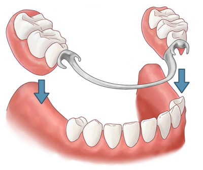 Протезирование зубов: несъемные протезы Acry-Free — съемные гибкие нейлоновые зубные протезы, мягкие протезы зубов  в Махачкале