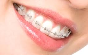 Ортодонтия. Исправление прикуса зубов с помощью брекет-систем  в Махачкале