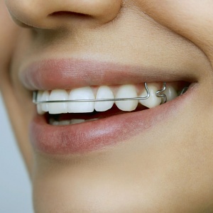 Исправление прикуса зубов быстро и качественно в «Стоматологии 32»